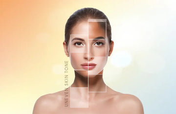 What is uneven skin tone
