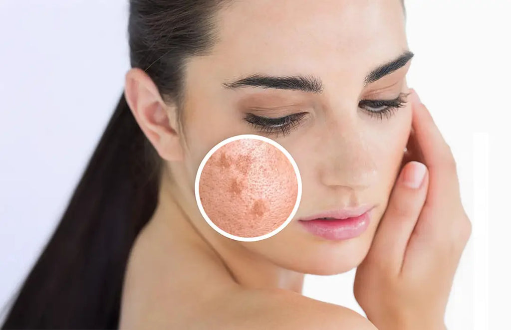 Glutathione for Hyperpigmentation: How Does It Work? Glutathione for Hyperpigmentation: How Does It Work?